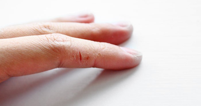 Почему трескается и сухая кожа на пальцах рук в руки thumbnail