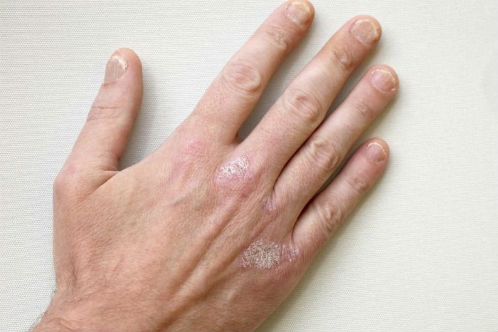Сухая кожа на костяшках пальцев рук причины и лечение thumbnail