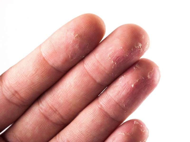От аллергии лопается кожа на руках thumbnail
